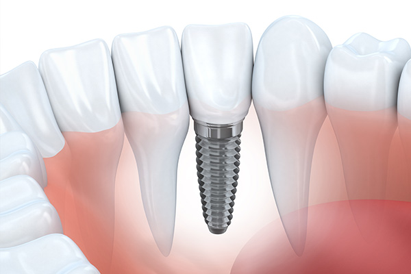 Dental Implants