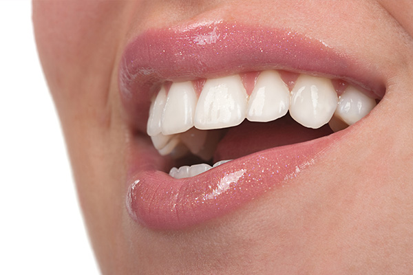 Porcelain Veneers