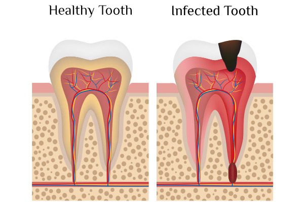 Root Canal